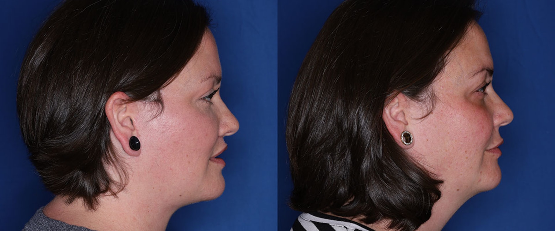 A Complete Guide to Neck Lift Surgery: Achieving Firmer, Youthful-Looking Skin