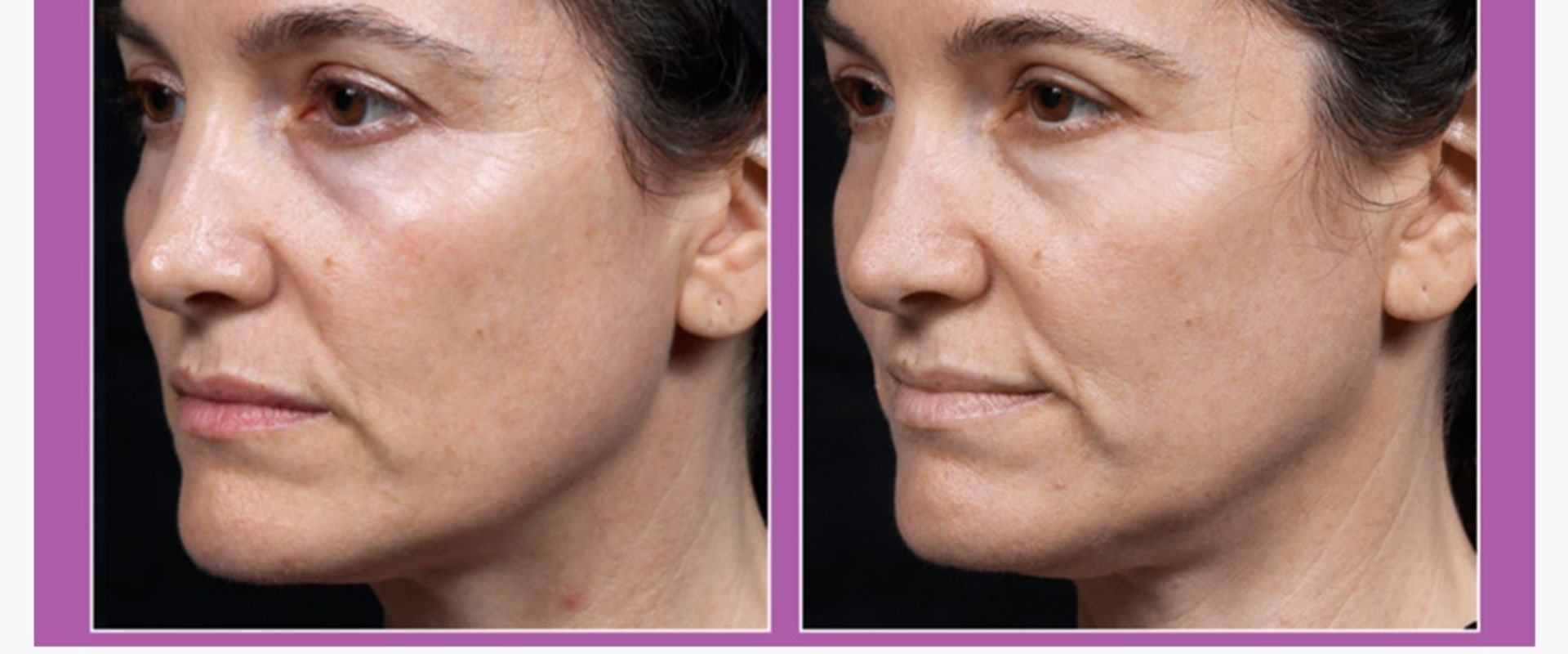 Radiofrequency Treatments for Skin Tightening