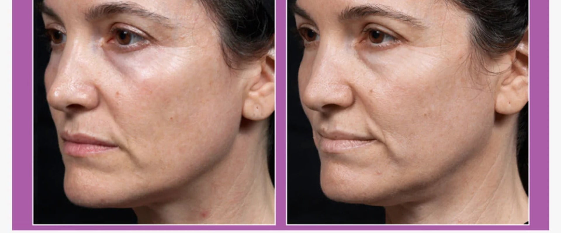 Maximizing Results: How to Effectively Use Skin Tightening Methods