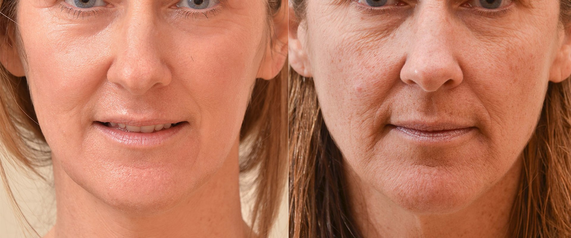 All You Need to Know About Laser Resurfacing for Skin Tightening