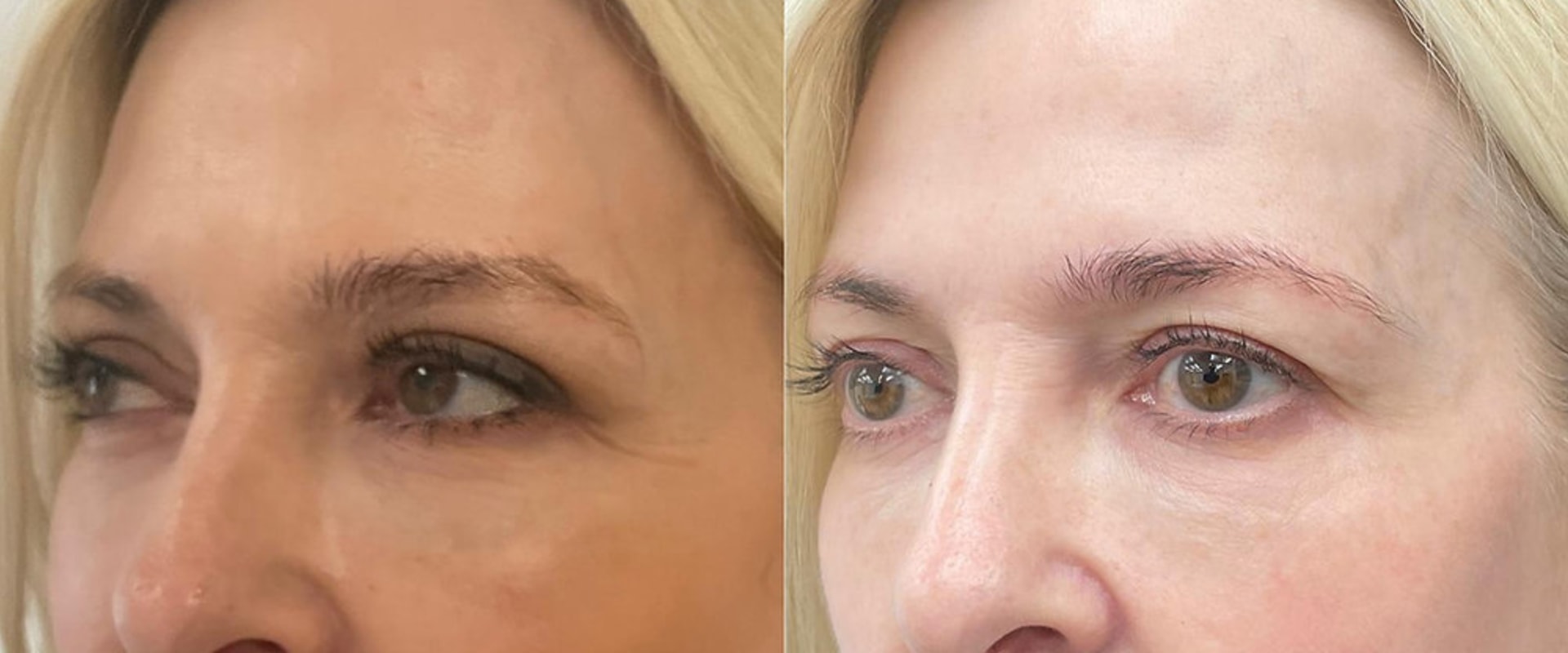 A Complete Guide to Brow Lift Surgery