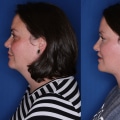 A Complete Guide to Neck Lift Surgery: Achieving Firmer, Youthful-Looking Skin