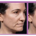 Radiofrequency Treatments for Skin Tightening