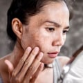 Understanding Skin Disorders and Their Impact on Sagging Skin