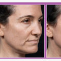 Maximizing Results: How to Effectively Use Skin Tightening Methods