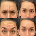 Understanding Botox Injections for Skin Tightening