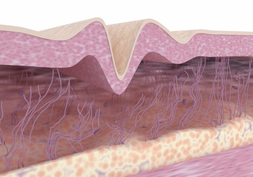 Understanding the Effects of Collagen and Elastin Breakdown on Skin Tightening