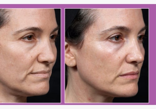 Radiofrequency Treatments for Skin Tightening