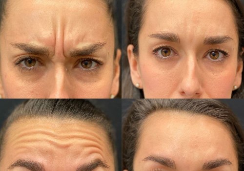 Understanding Botox Injections for Skin Tightening