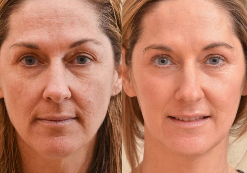 All You Need to Know About Laser Resurfacing for Skin Tightening