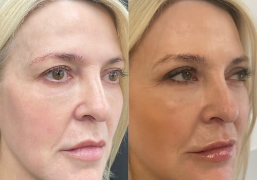 A Complete Guide to Brow Lift Surgery